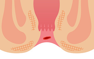 切れ痔