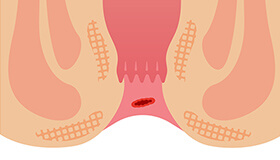 切れ痔