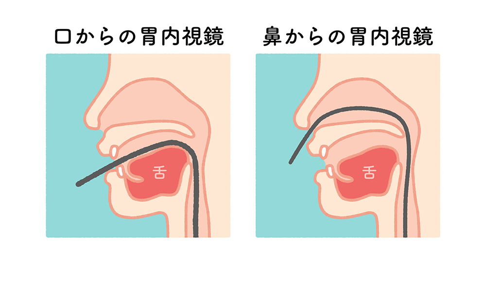 経口・経鼻内視鏡をご選択いただけます