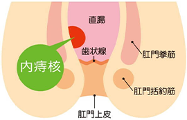 内痔核