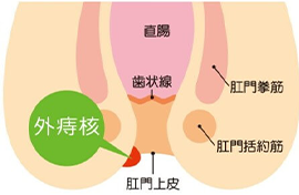 外痔核