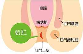 肛門のよくある疾患 disease