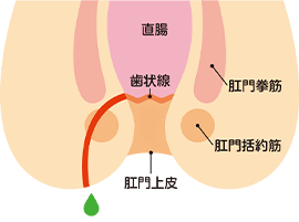 肛門のよくある疾患 disease