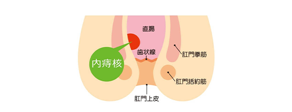 内痔核