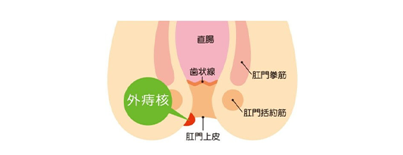 外痔核