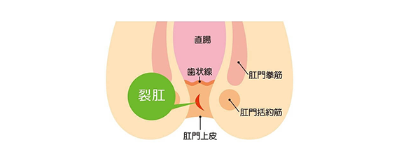 肛門のよくある疾患 disease