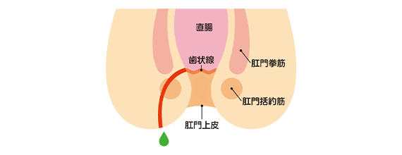 肛門のよくある疾患 disease