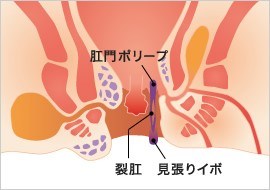 見切りイボ