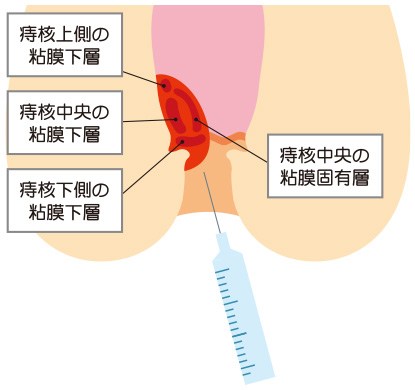 ジオン注射