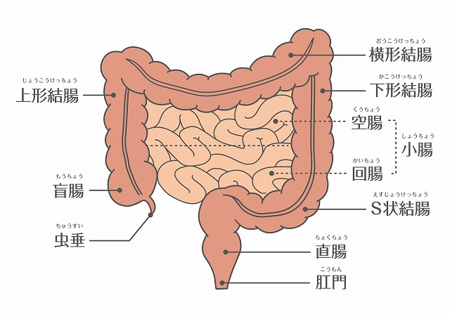 大腸がんの種類